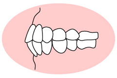 上下顎前突（じょうげがくぜんとつ））