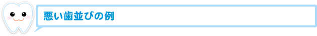 悪い歯並びの例