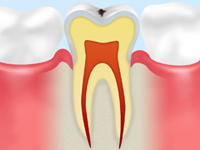 C0【ごく初期のむし歯】