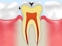 C1【エナメル質のむし歯】