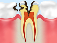 C3【神経まで達したむし歯】