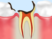 C4【歯根まで達したむし歯】】